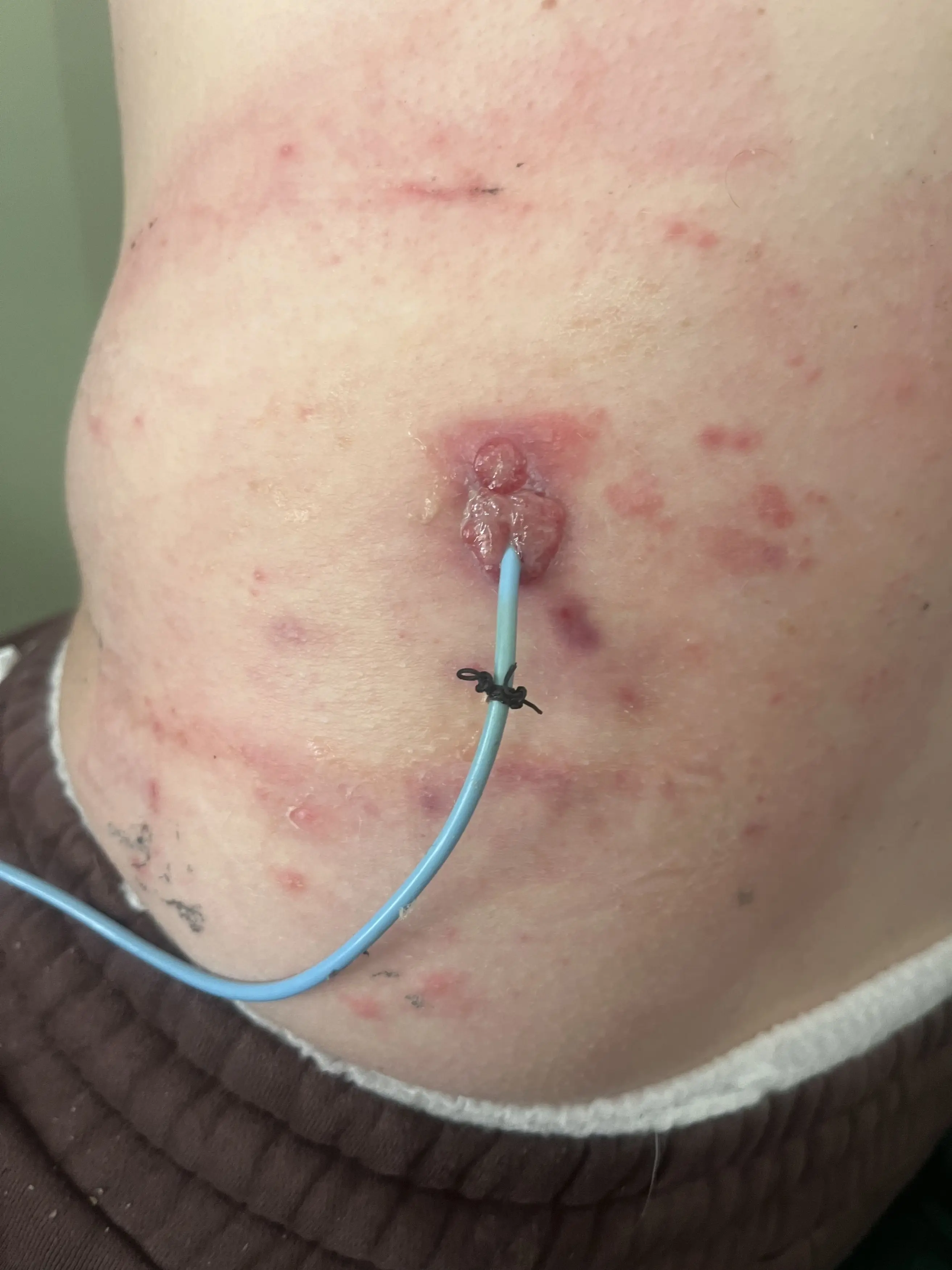 Jordan has gone 'cold turkey' after having a colostomy bag fitted, as using the drug with one could kill her (Kennedy News and Media)