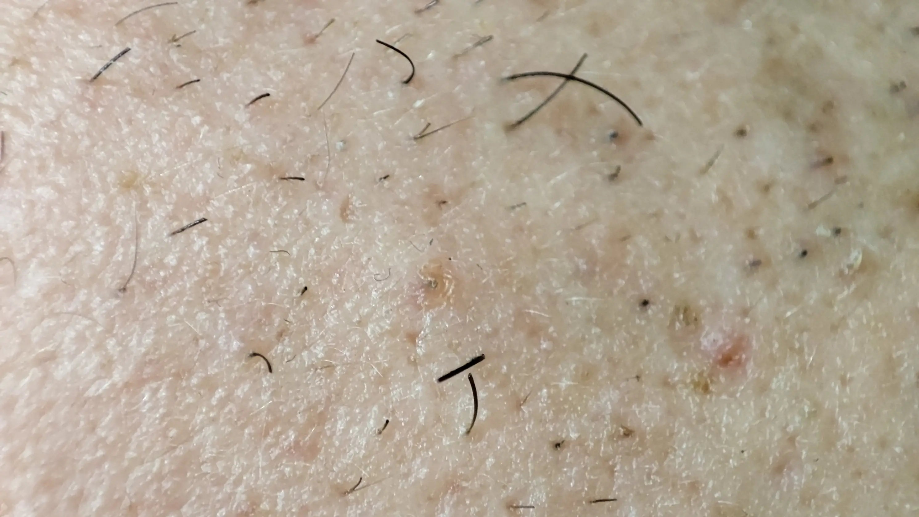 Ingrown hairs are common if you regularly shave your intimate areas (photo_Pawel/Getty Images)