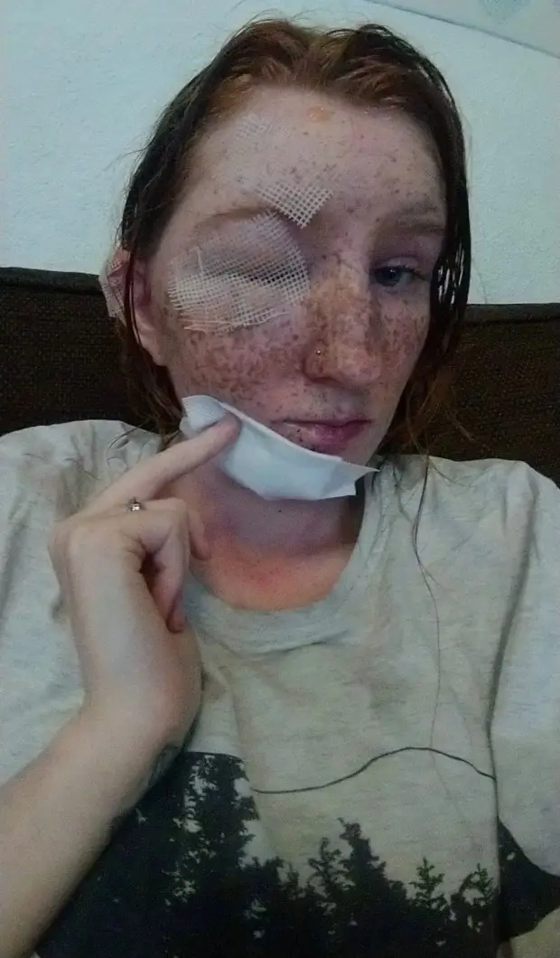 She suffered 'painful injuries and was treated in a specialist burns unit.