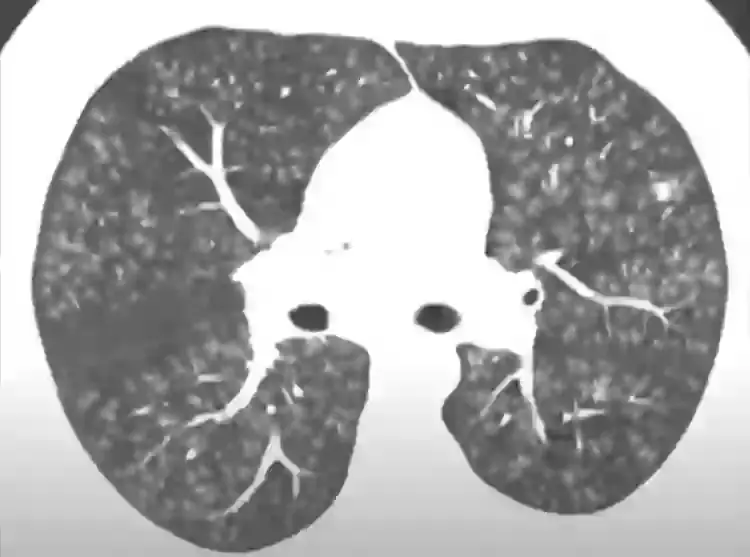 An x-ray showing the damage done by 'popcorn lung' (CBS)