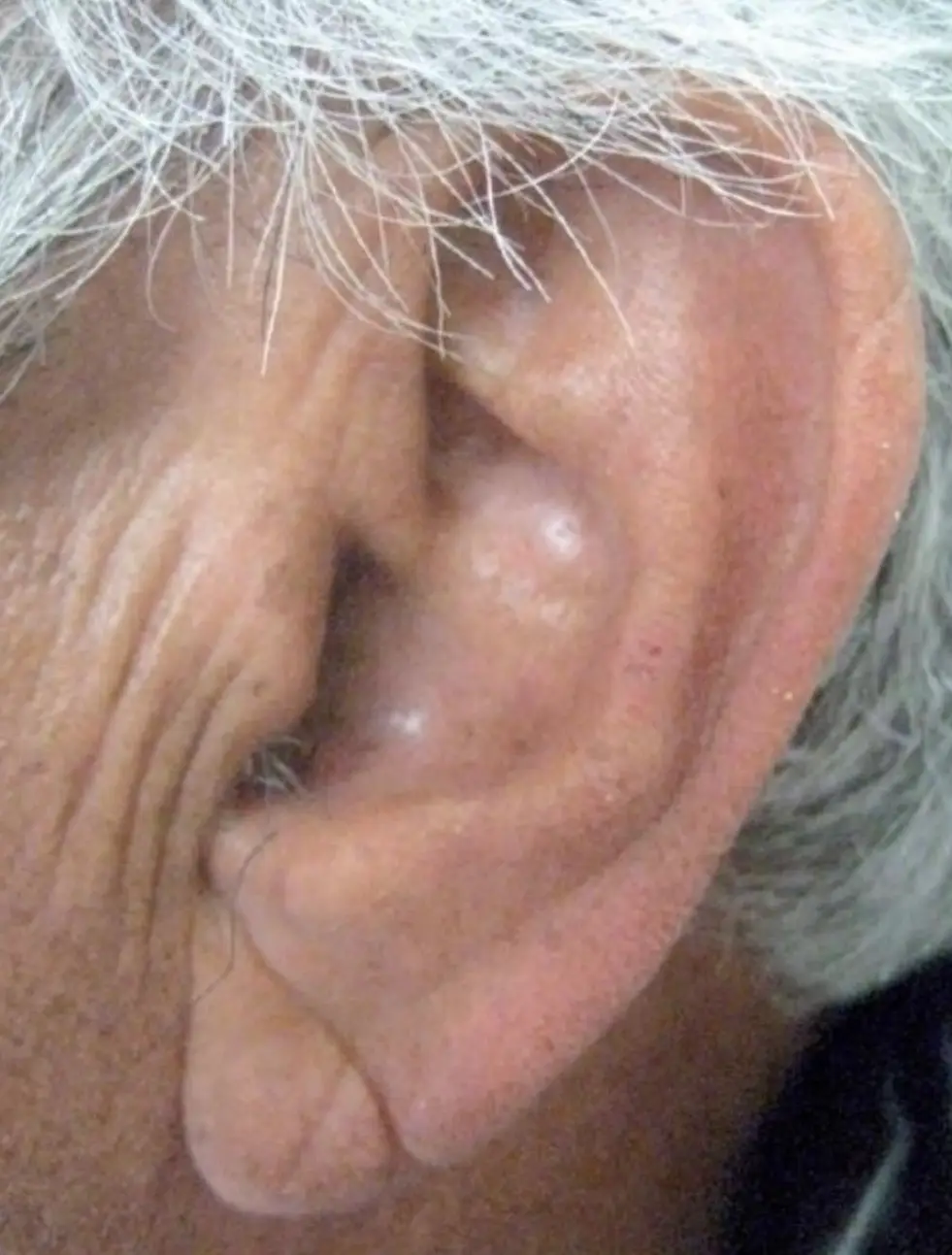 If you've got a crease in your earlobe, you could be at a greater risk of suffering from serious heart problems (Stanford Medicine)