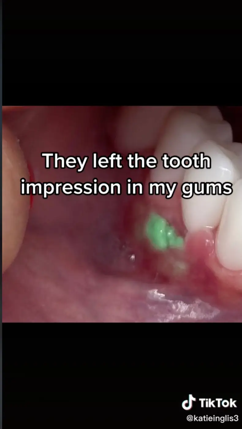 Her gums were visibly left filled with green putty.