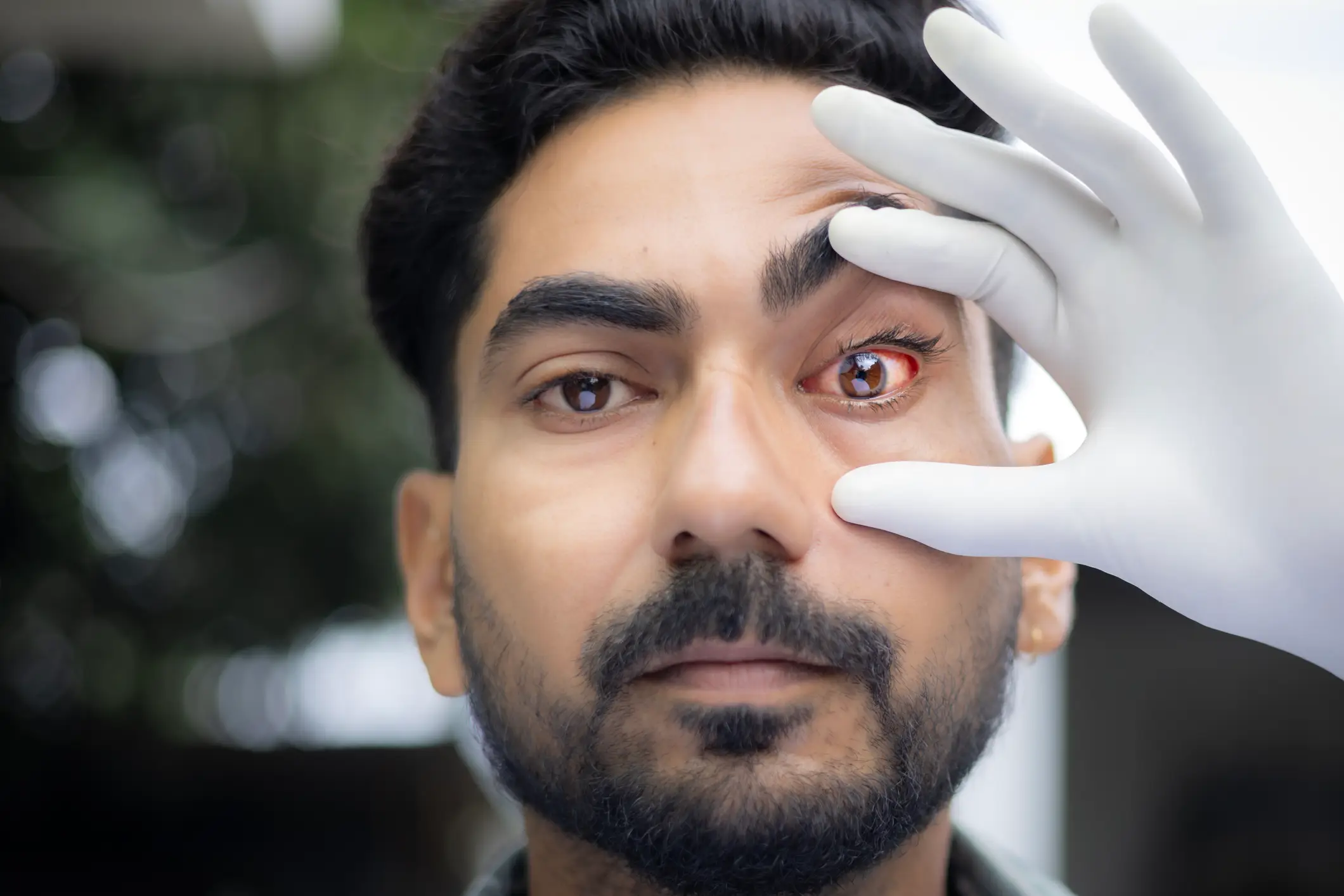 Conjunctivitis, or pink eye, is a common eye infection that can cause vision loss if left untreated (Getty Stock Images)