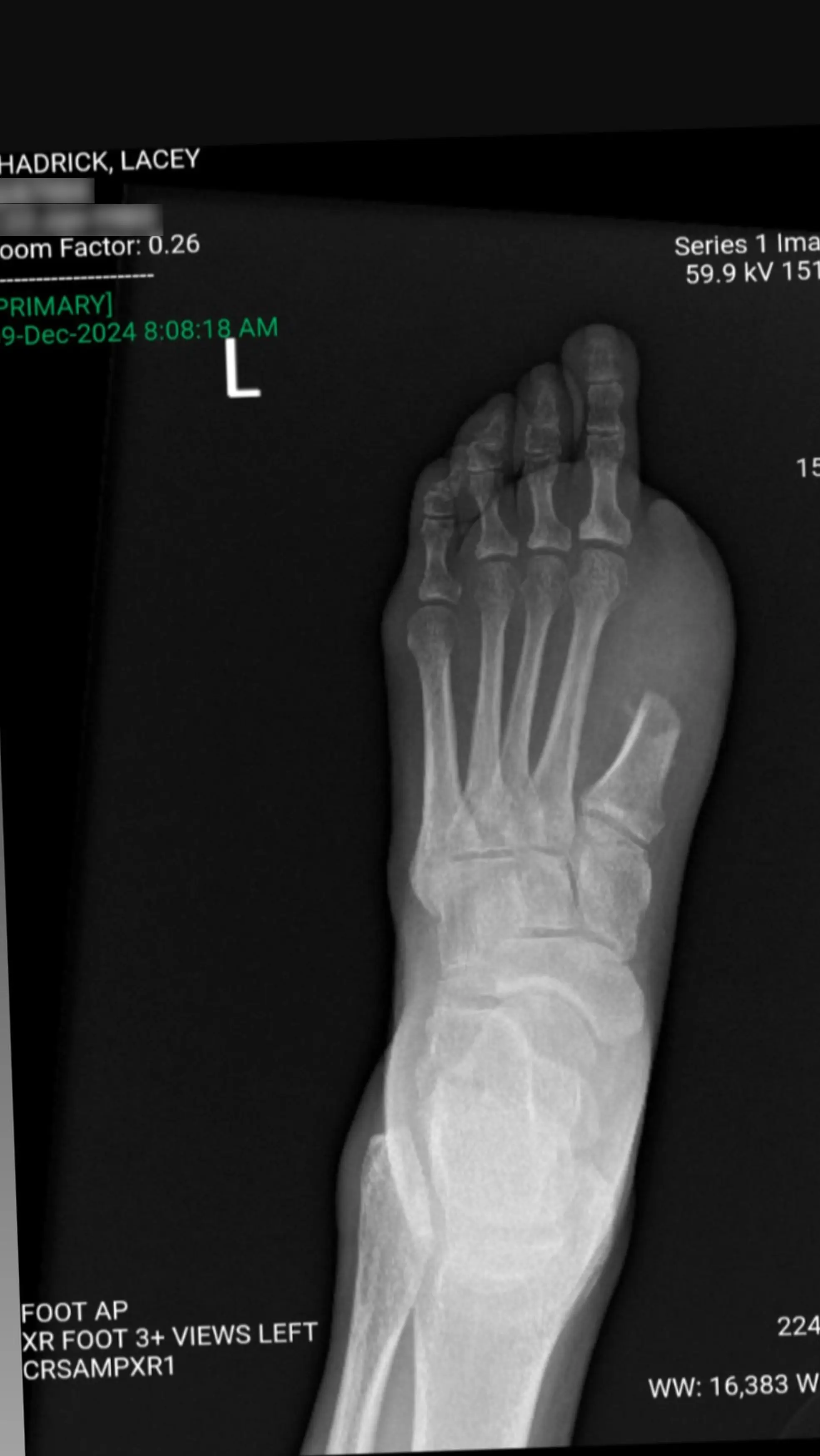 Her big toe had to be amputated, months later she lost them all (Kennedy News and Media)