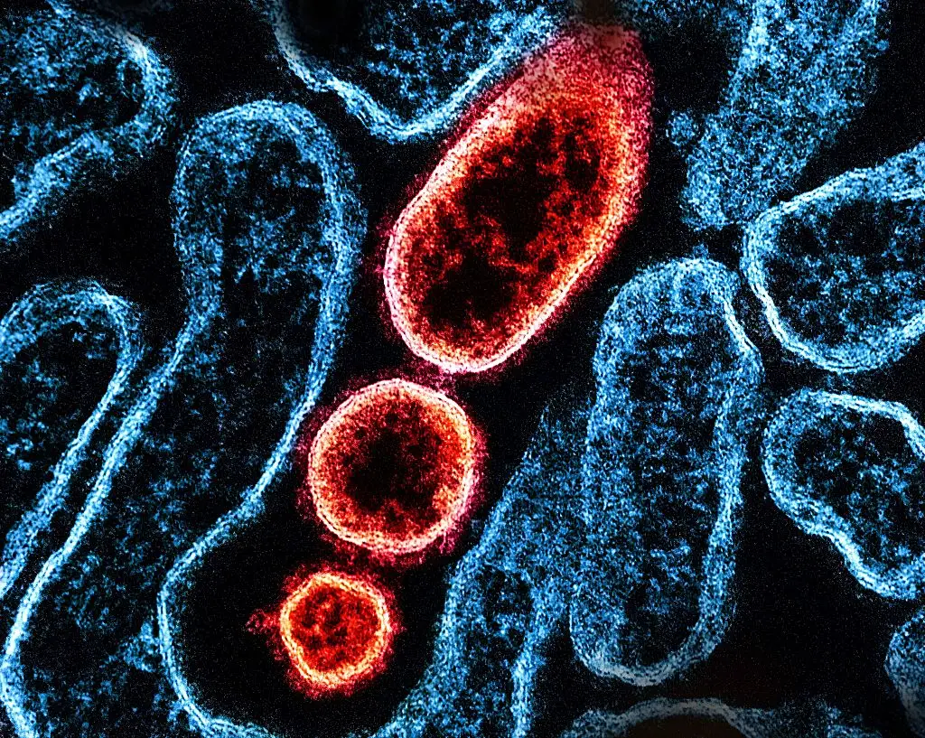 'Fever, headaches, myalgia (muscle pain), vomiting and sore throat' are the reported symptoms of Nipah virus (NIH-NIAID/Image Point FR/BSIP/Universal Images Group via Getty Images)