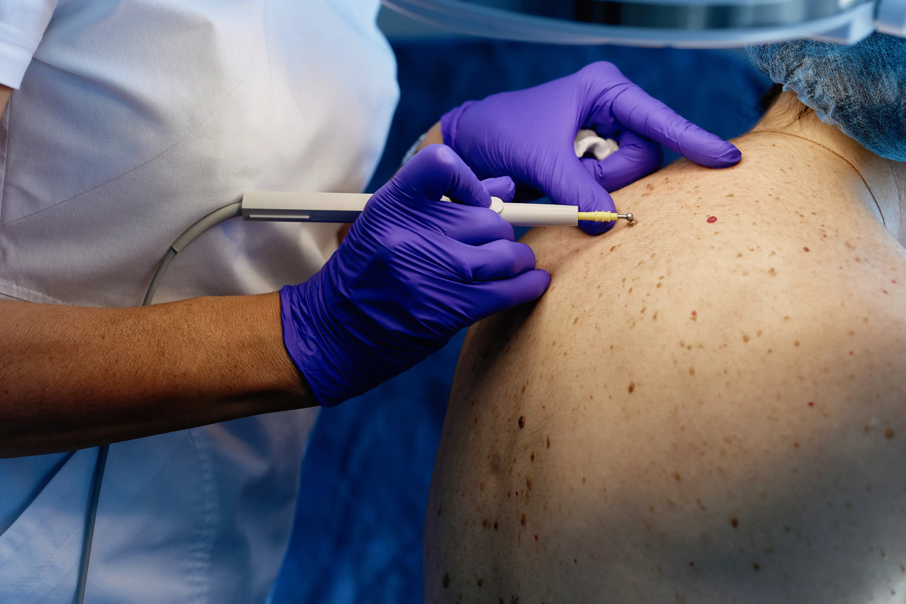 It's best to get any suspicious marks or moles on your body checked out by a medical professional (Getty Stock Photo)