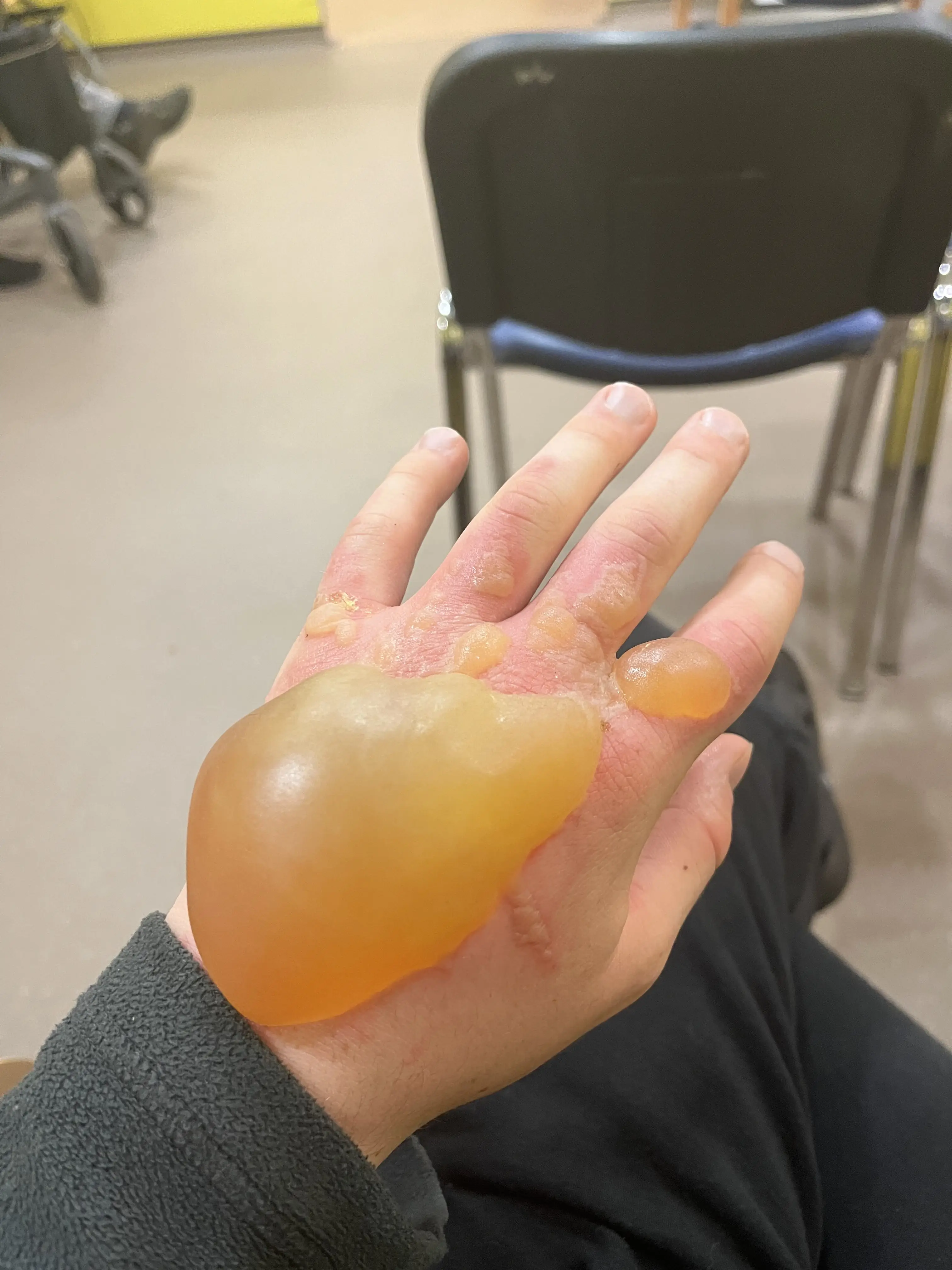 The worst blister ballooned up to the size of an orange. (Pen News)