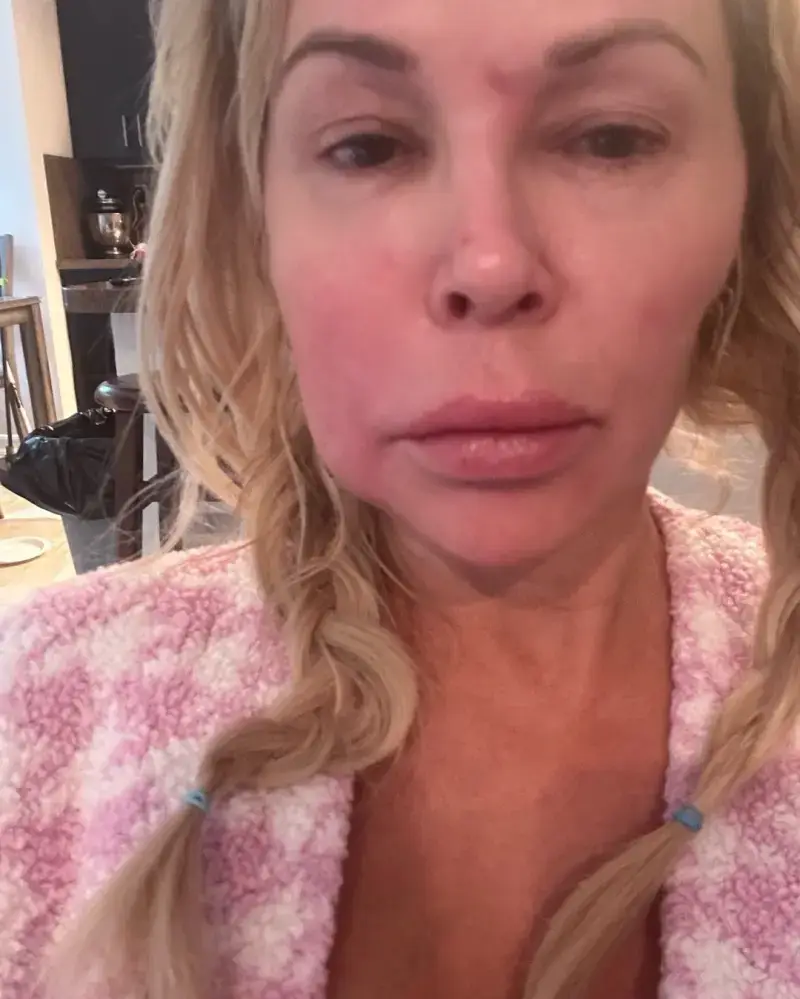 The reality star said breast implants was the cause of her facial parasite (Instagram/@brandiglanville)