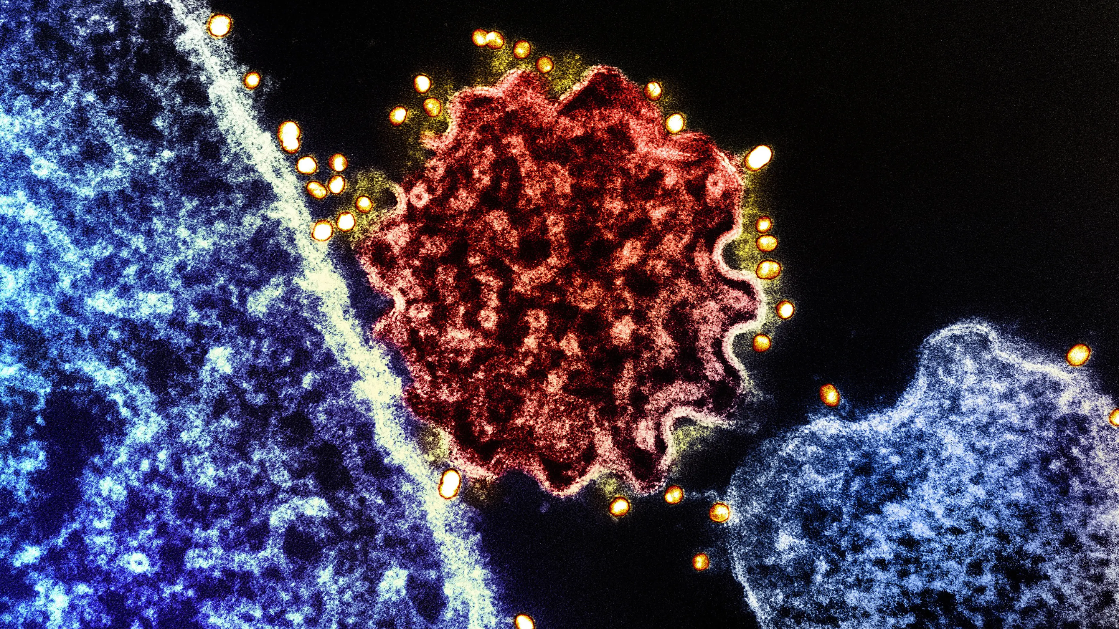 NIH-NIAID/Image Point FR/BSIP/Universal Images Group via Getty Images