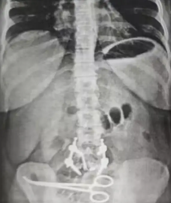 The scissors were stuck in her abdomen for three months (Newsflash/NX)