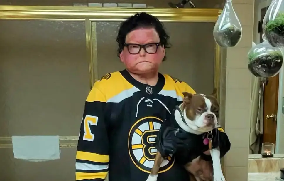 Joe DiMeo was underwent the world's first successful face and double hand transplant (Instagram/JoeDiMeo)