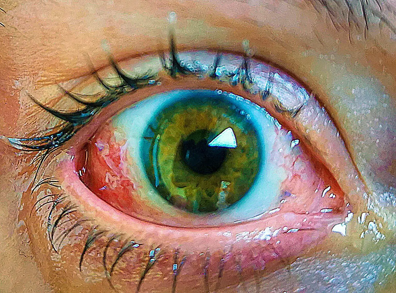 She was later diagnosed with uveal melanoma, a rare type of eye cancer (SWNS)