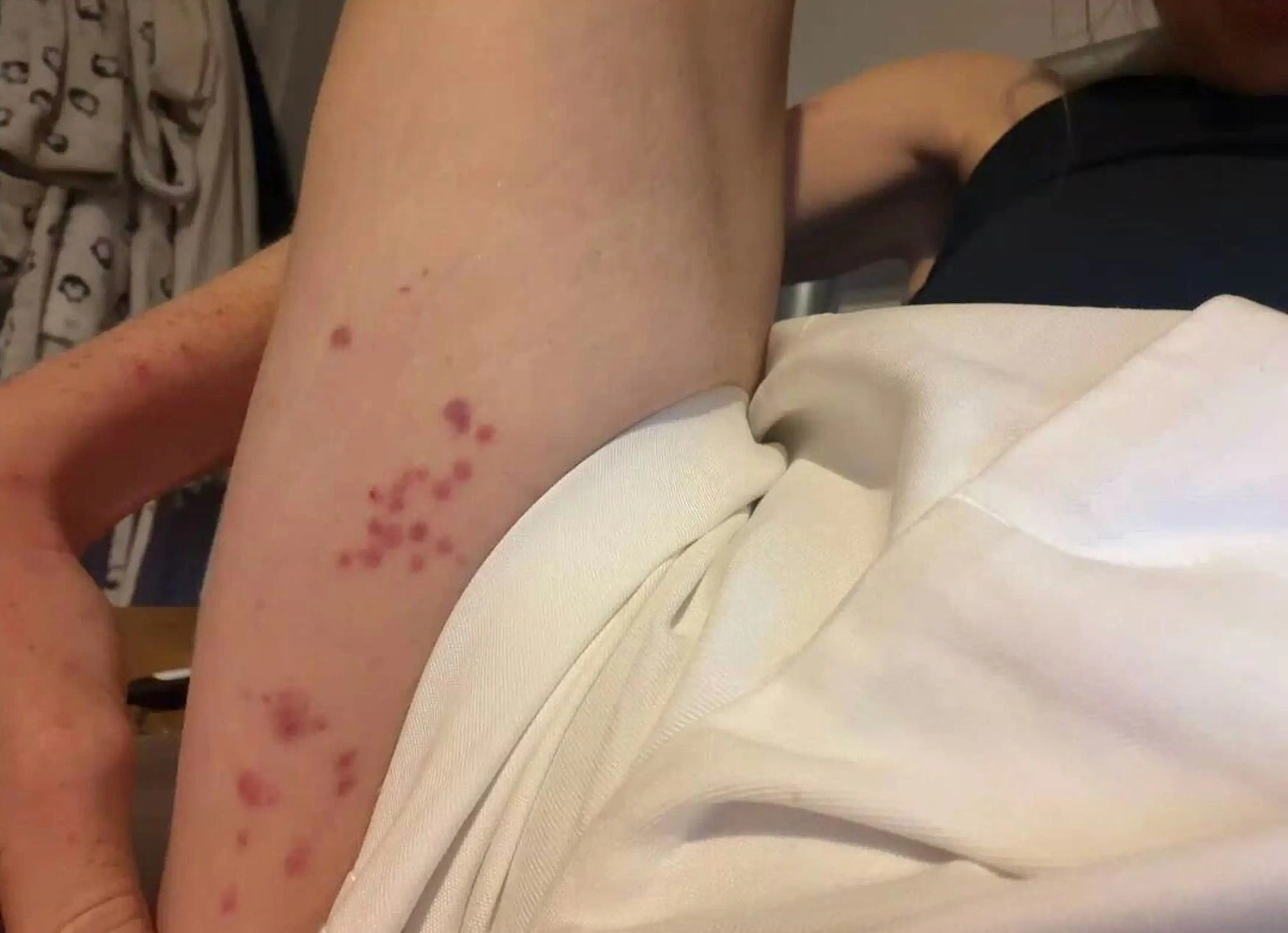 Hannah's body was covered in the red bites (Kennedy News and Media)