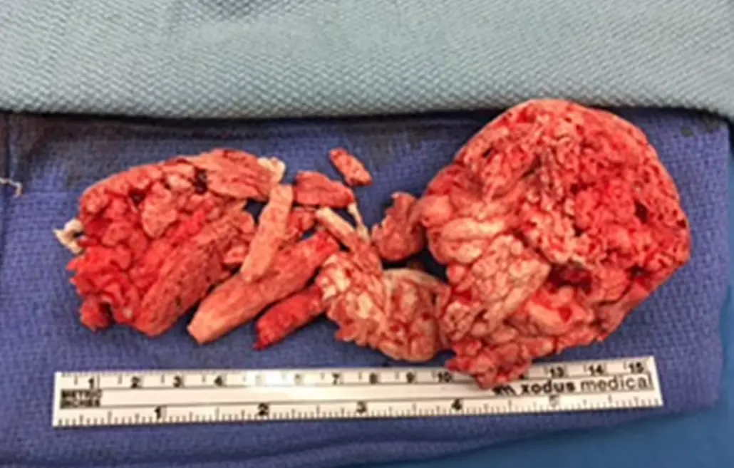 The foam that was removed from his body.