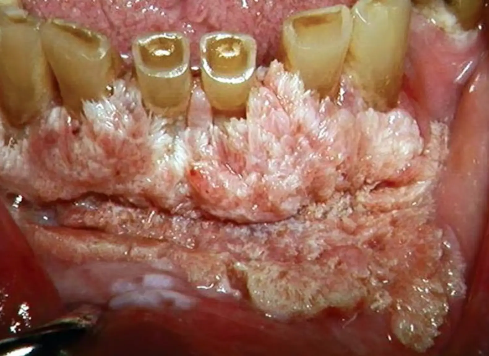 The doctor said this was an extreme example of the damage chewing tobacco could do (YouTube/Katranji & Nemeth DDS)