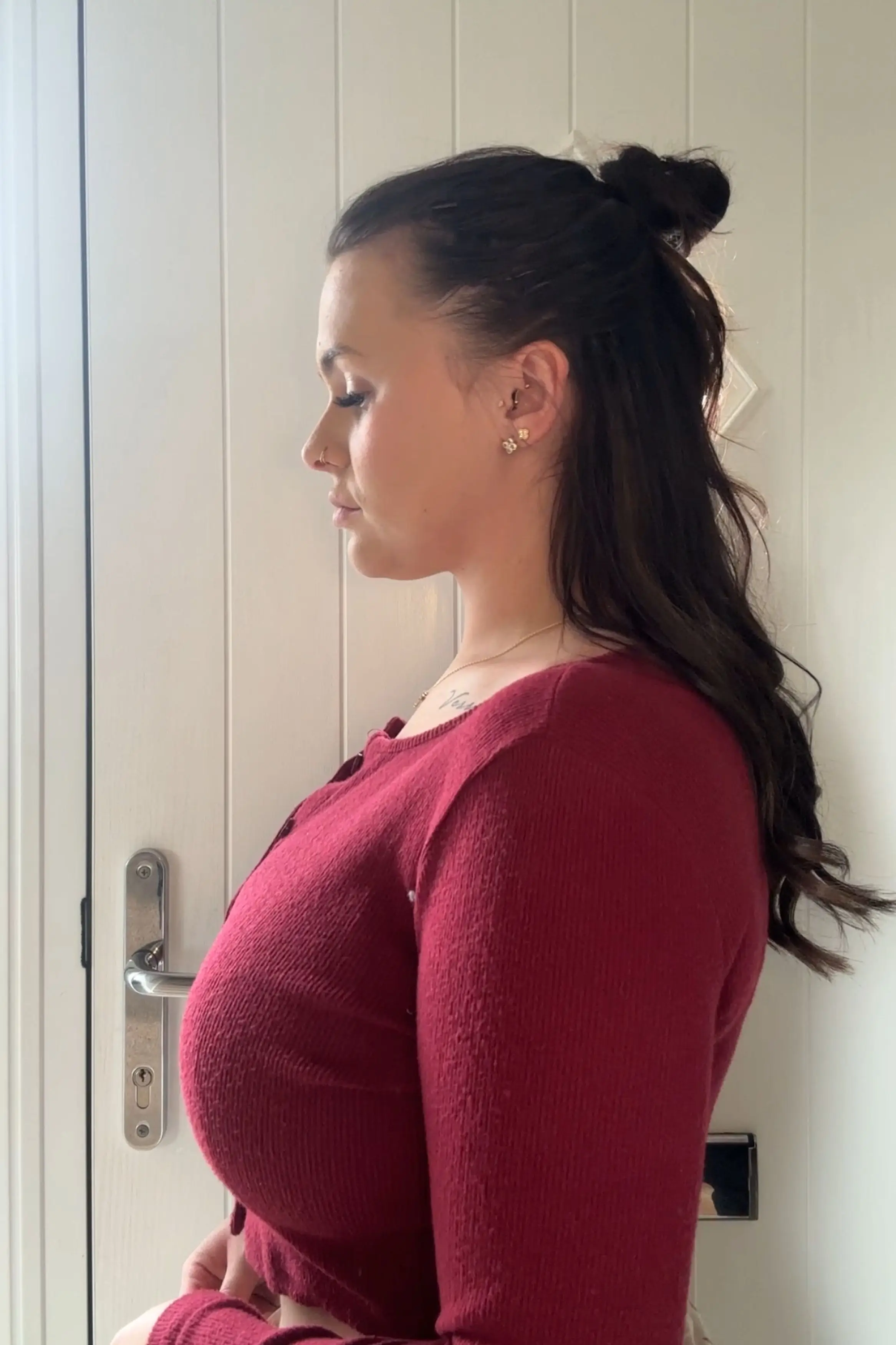 A spine with kyphosis has a bigger curve at the top compared to a spine without kyphosis (Kennedy News and Media)