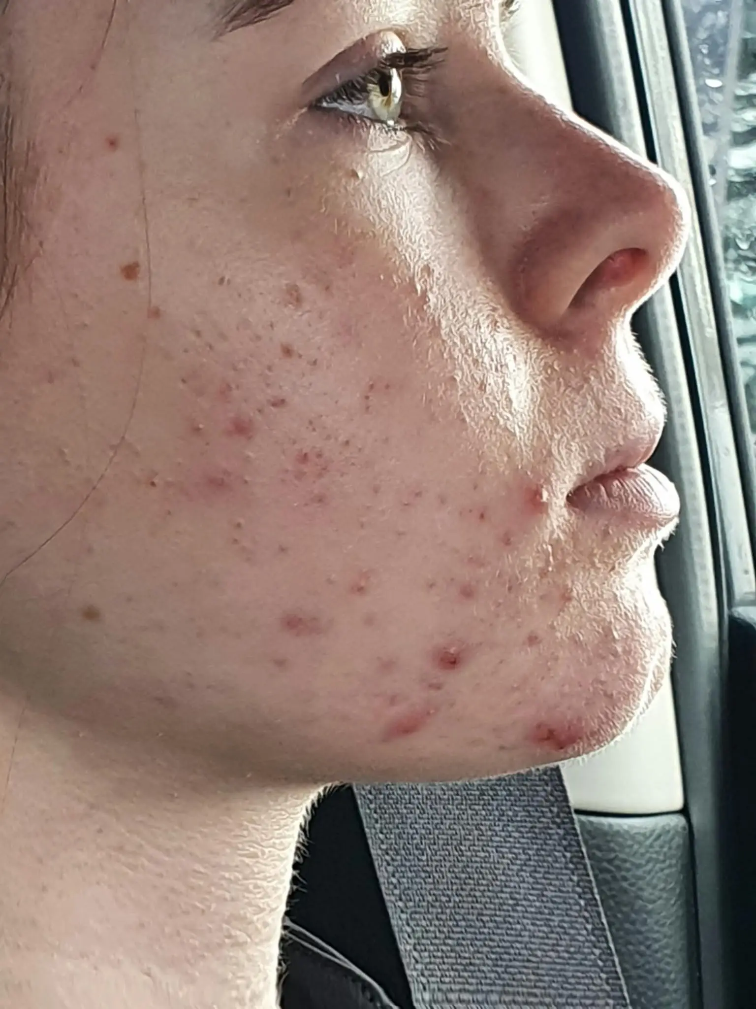 Acne was just one of the symptoms she suffered along with nausea, vomiting and severe migraines (SWNS)