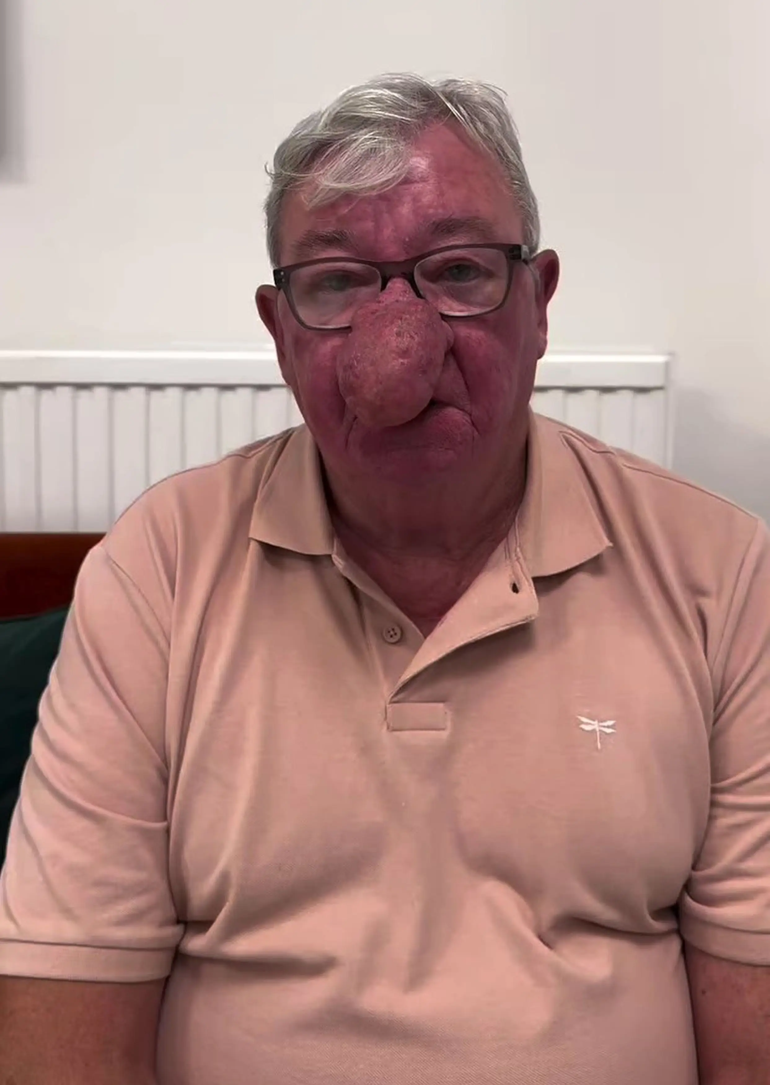 The pensioner noticed his nose growing 10 years ago, but didn't initially think much of it (Kennedy News and Media)