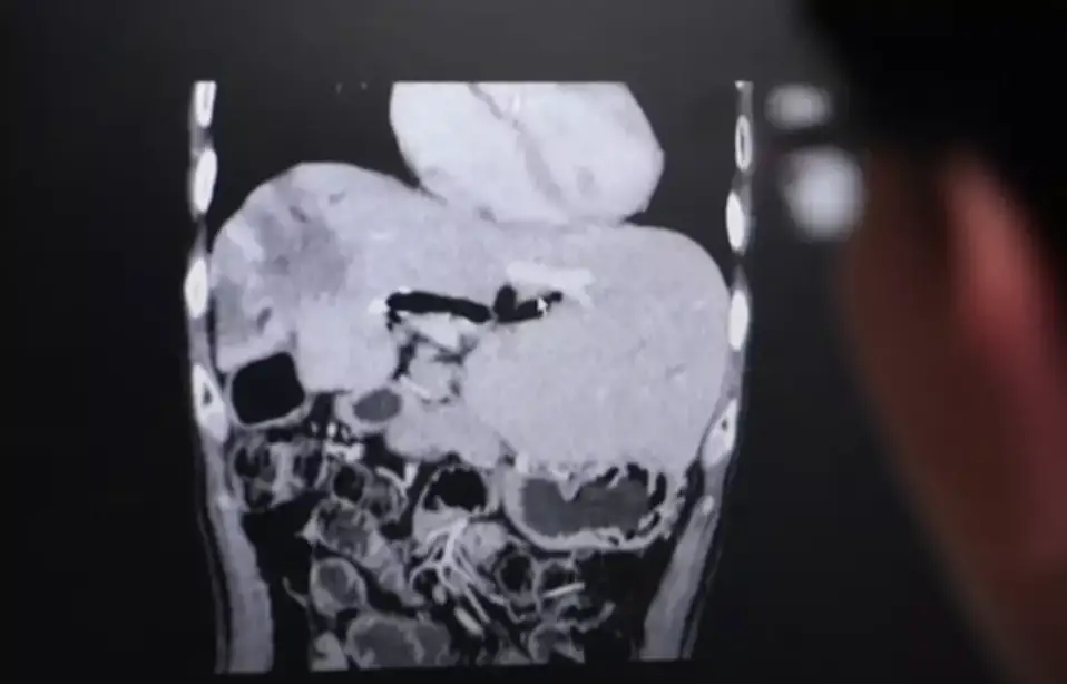 This harrowing X-ray displays the parasite in the host's body (BBC)