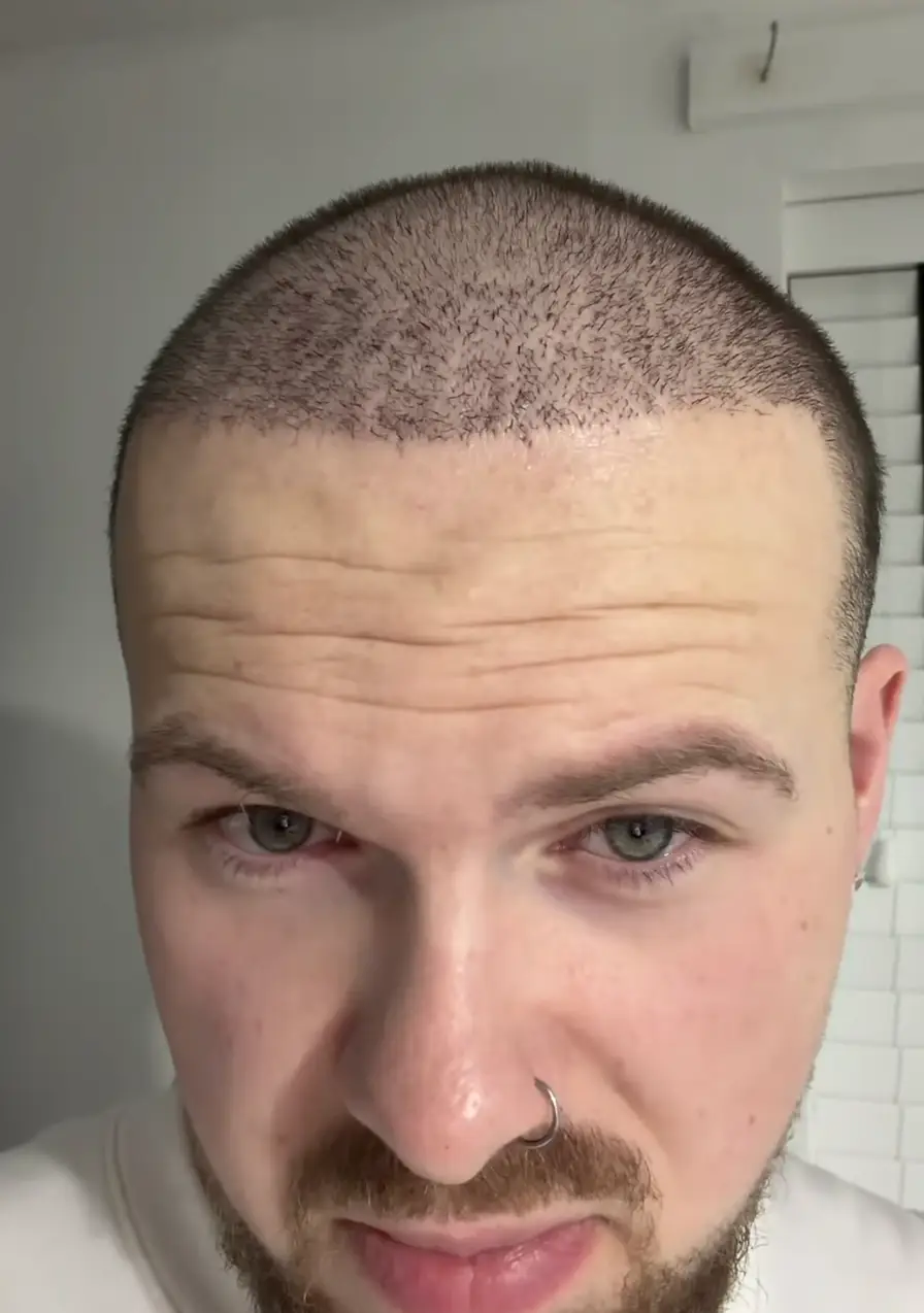 Two weeks on, his hair looked noticably healthier and his hairline was lined up (Instagram/cuts_by_lb)