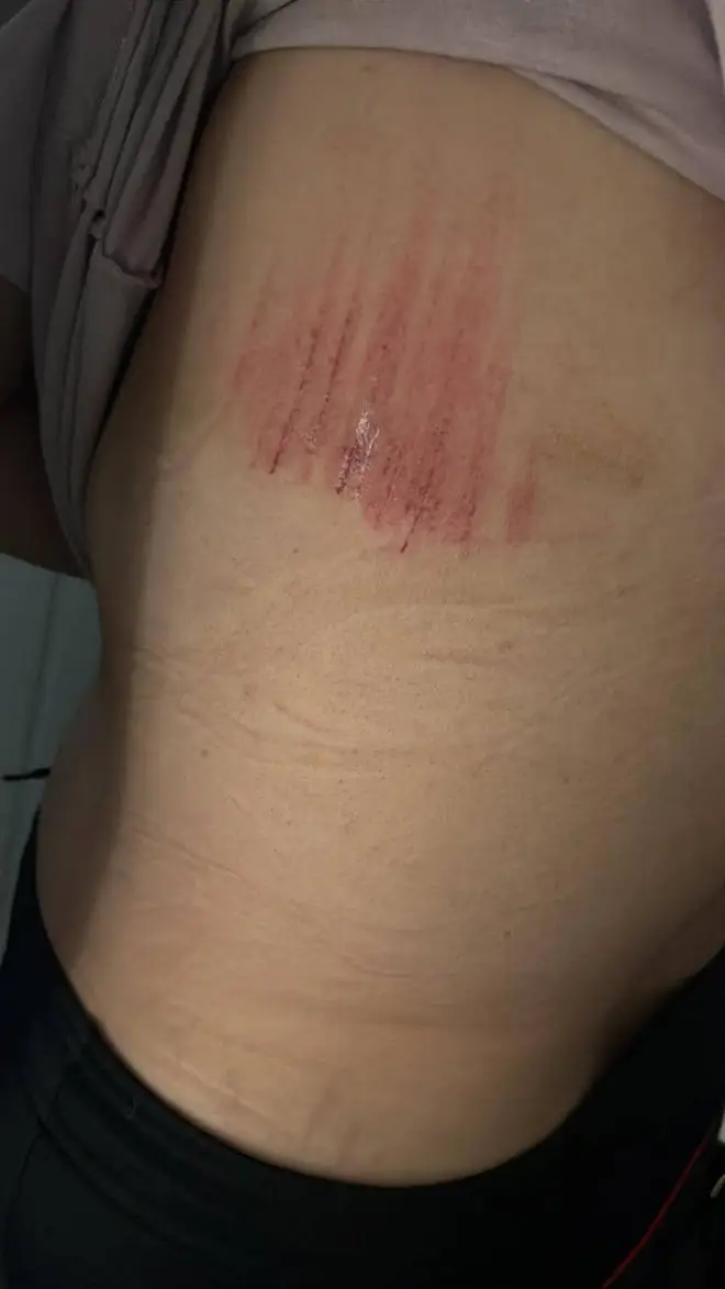 She picked up a nasty graze.