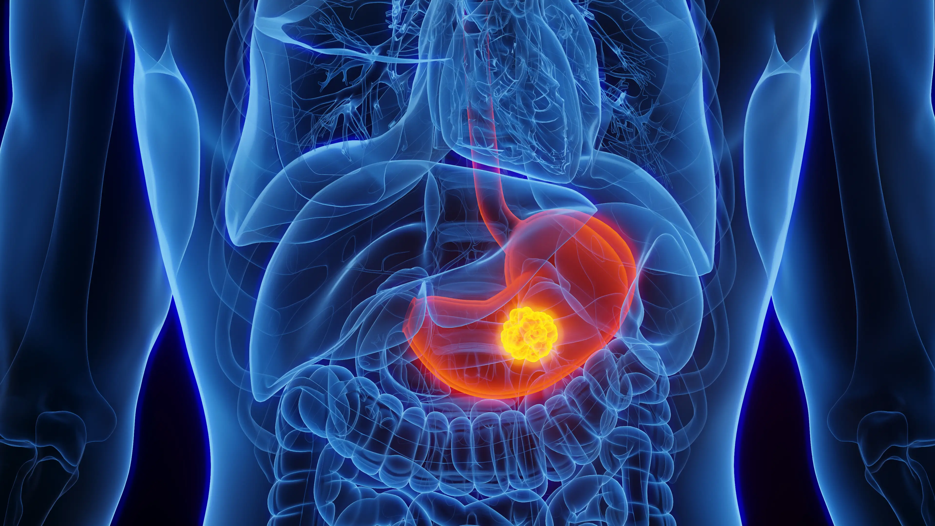 It seems stomach cancer is on the rise in the US. (	SEBASTIAN KAULITZKI/SCIENCE PHOTO LIBRARY)