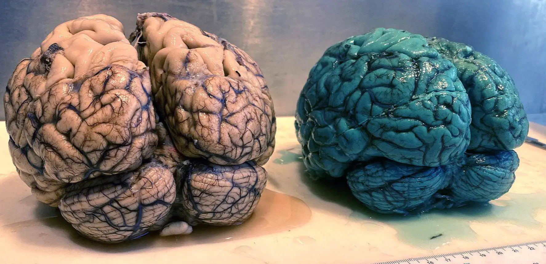 The patient's brain, compared to a normal presenting brain (Wikimedia Commons)