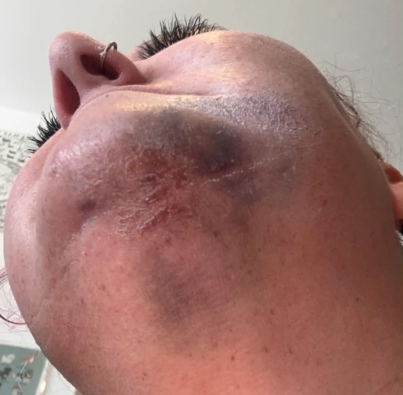 Vic's face was injured after she became incapacitated (Vic Dooney)