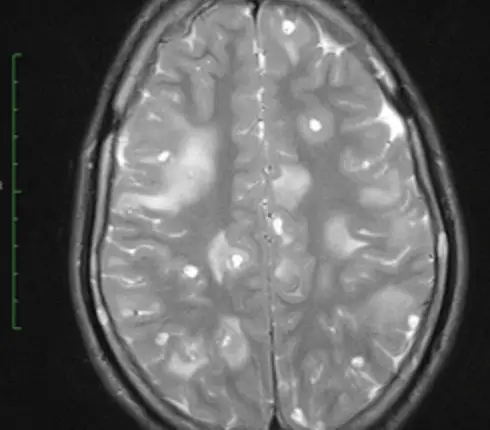 The CT Scan of her brain (RSNA)