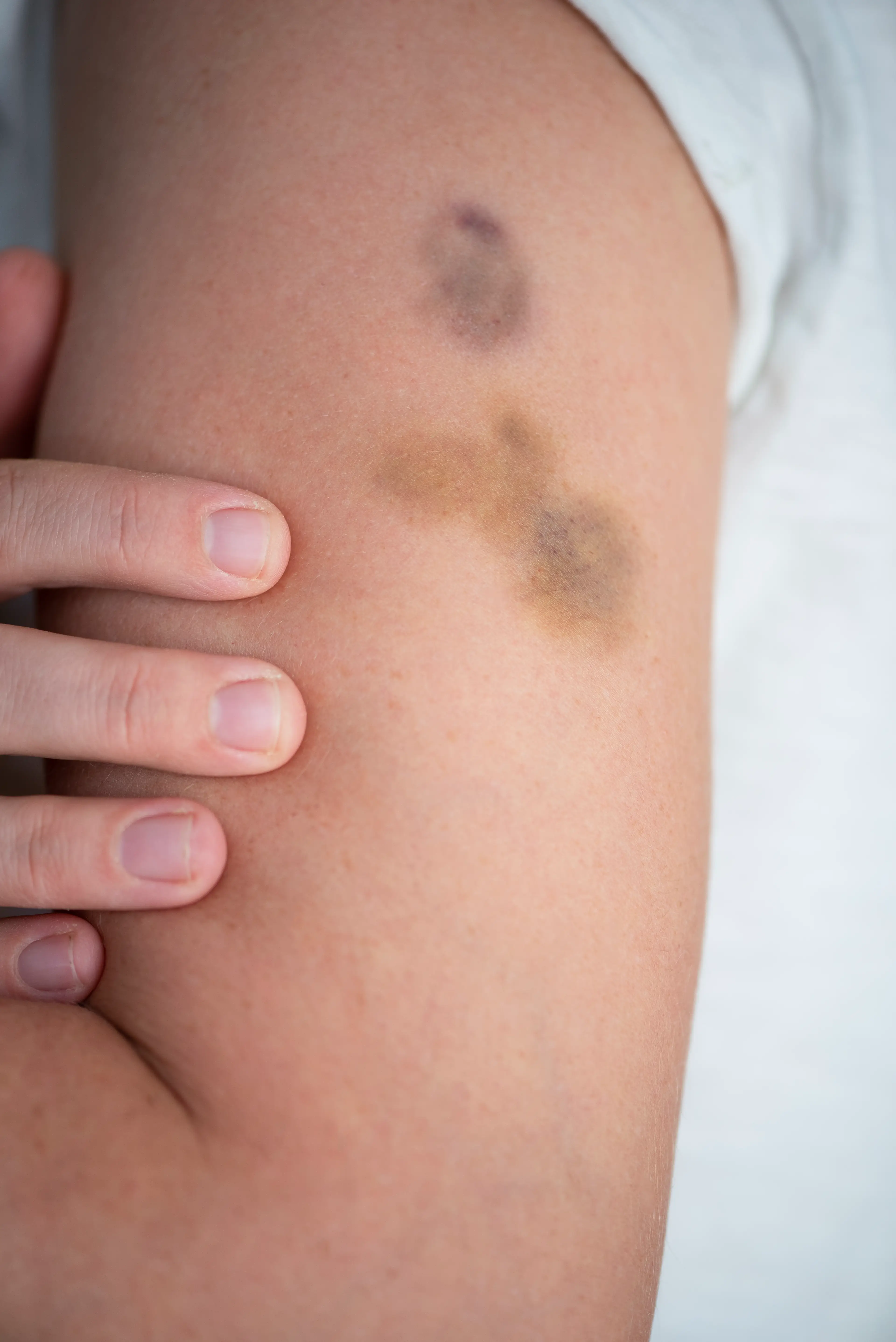 The causes of frequent bruising have been revealed (Getty Stock Images)