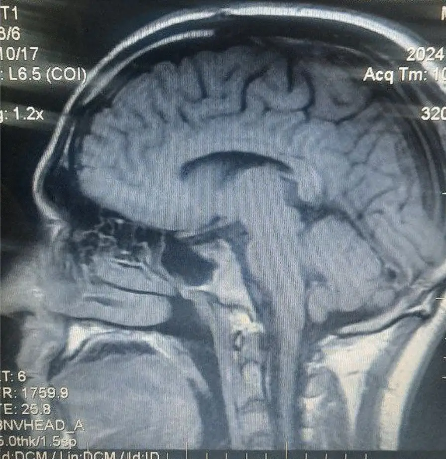 The main sought medical attention after struggling with a runny nose, headaches and seizures (Kenana Tawashi et al)