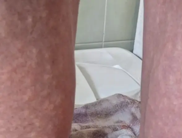 She said a rash she got close to the marathon might have had something to do with it (Instagram/@eilishmccolgan)