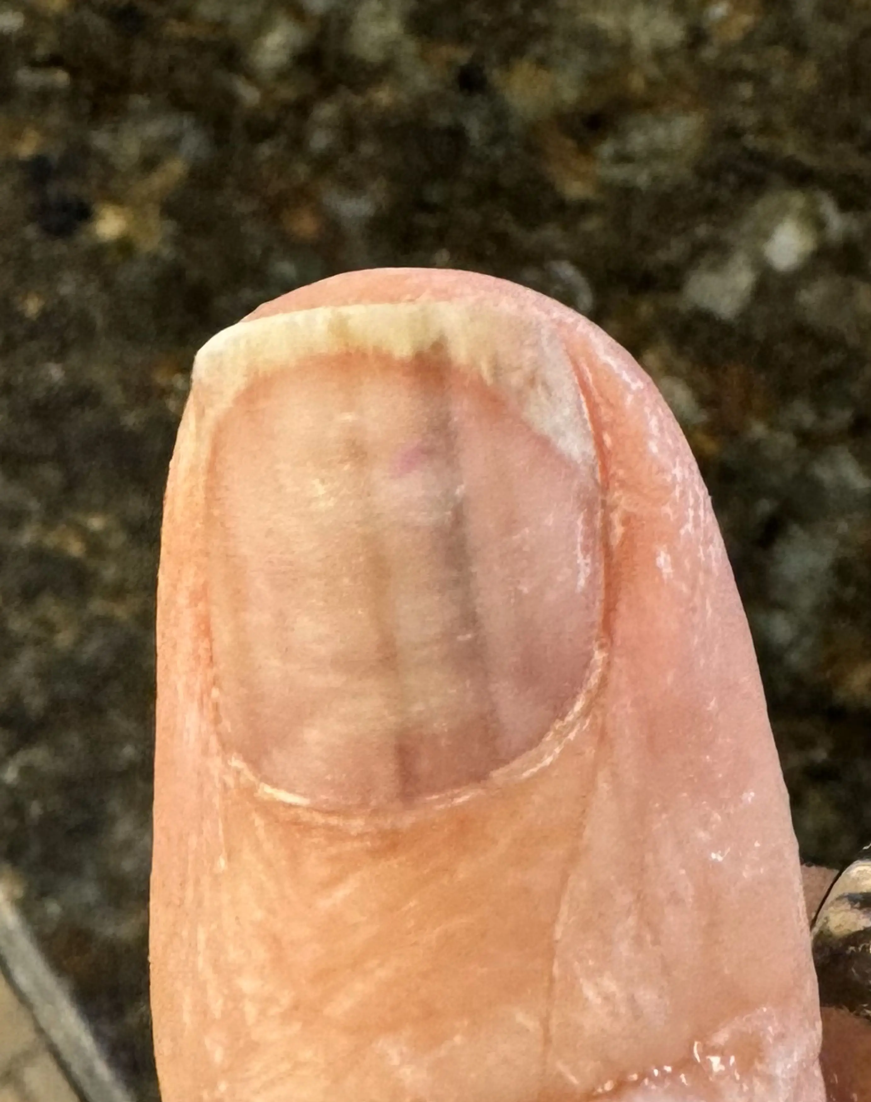 The mum-of-two explained she spotted some strange black lines appear on her right thumbnail (Kennedy News and Media)