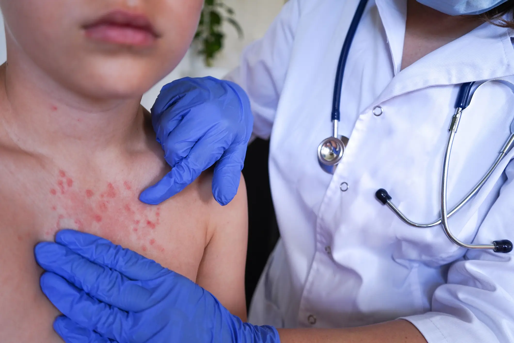 It leaves people with nasty rashes and often uncontrollable itching (Getty Stock)