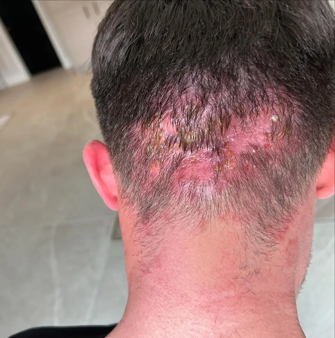 Gaz opened up about the health condition with his followers. (Instagram/@gazbeadle)