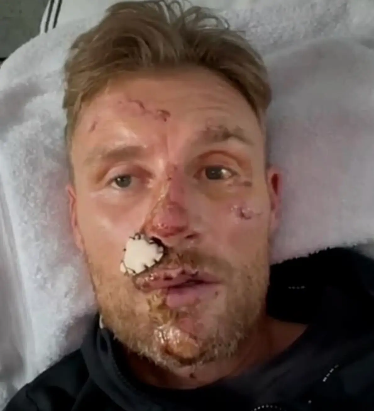 Freddie Flintoff suffered horrendous injuries to his face as a result of the Top Gear crash. (BBC)