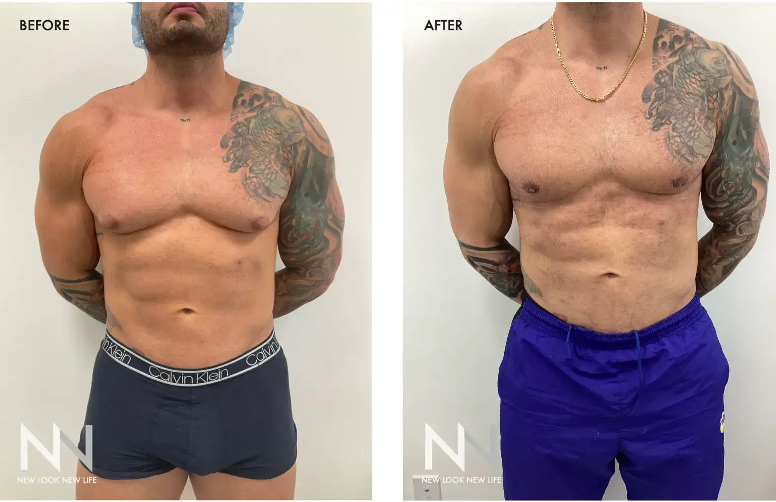 Bueno went in for surgery on his chest to tackle the side effect from steroid use (New Look New Life)