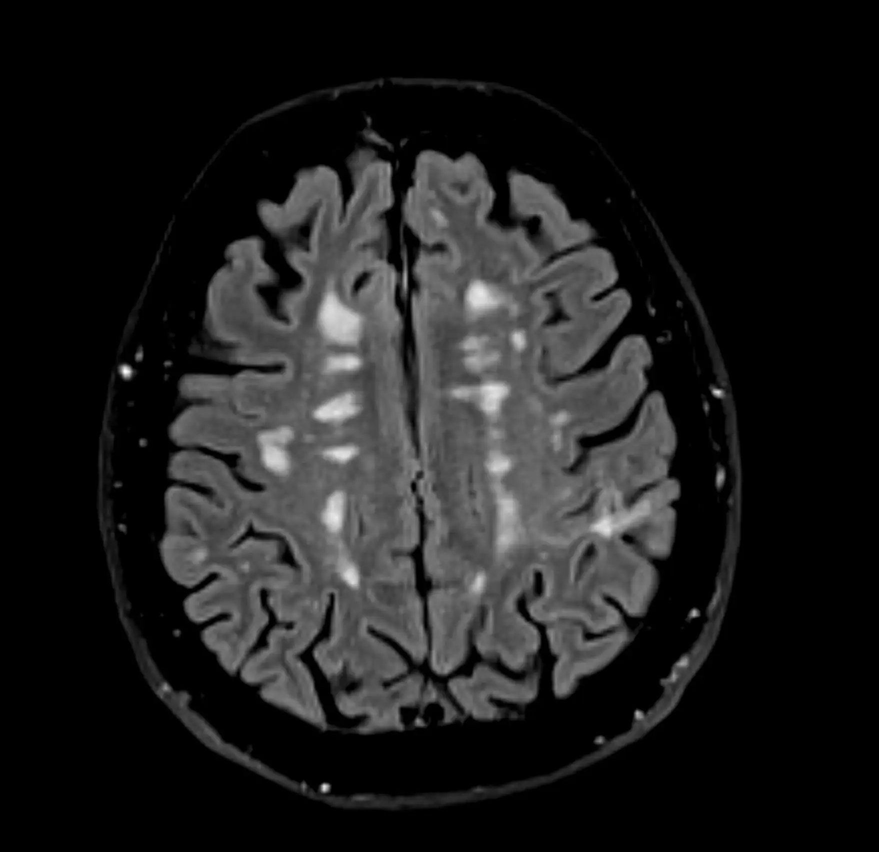  Magnetic Resonance Imaging showing Multiple Sclerosis (Getty Images)