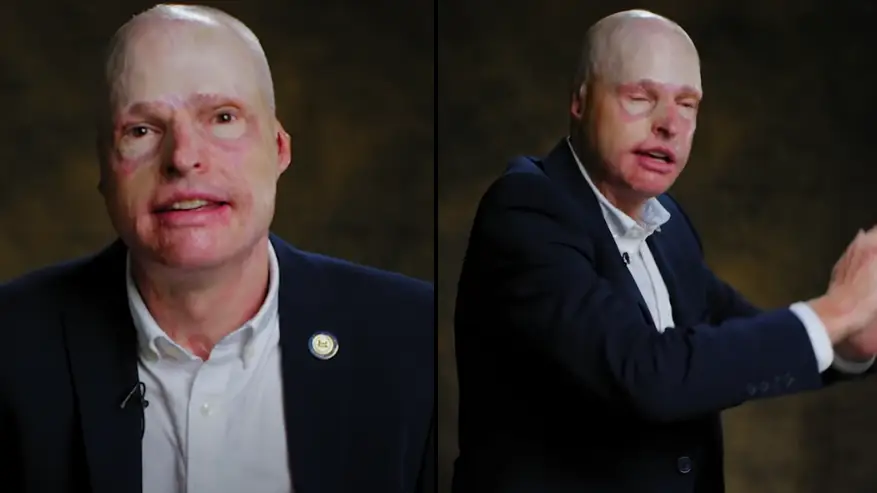 Pilot who survived a plane crash with 63% third degree burns explained the experience