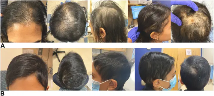 A case report reveals the patient's hair loss (National Library of Medicine)