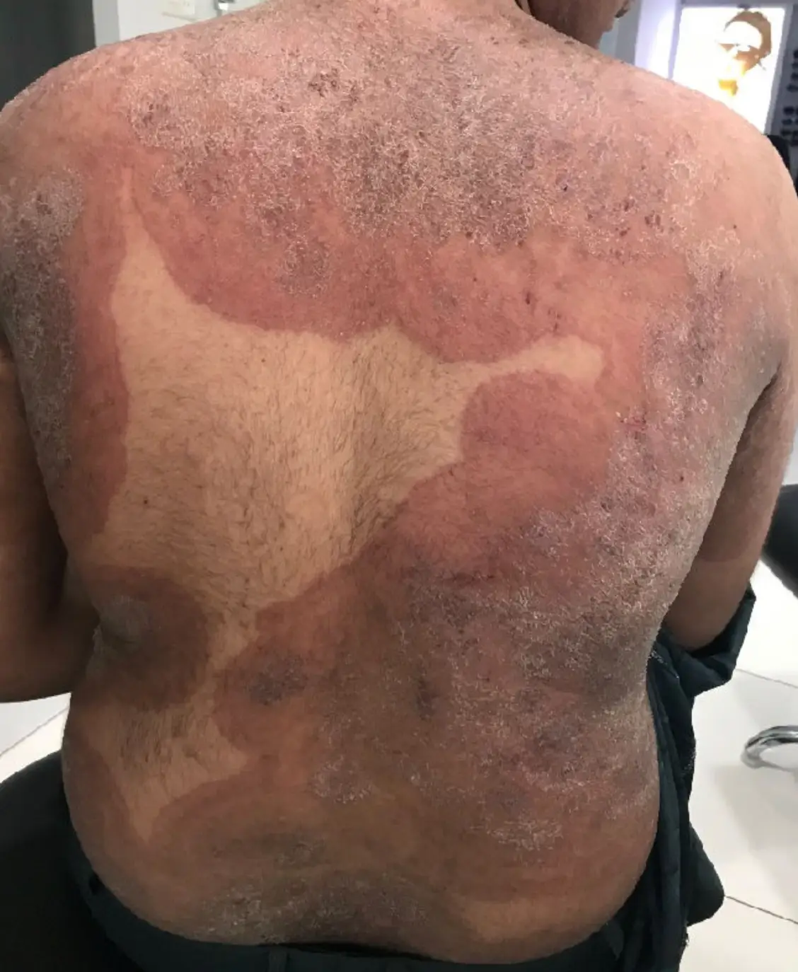 While cases remain low, the condition can spread easily and shouldn't be confused with eczema (MDPI)