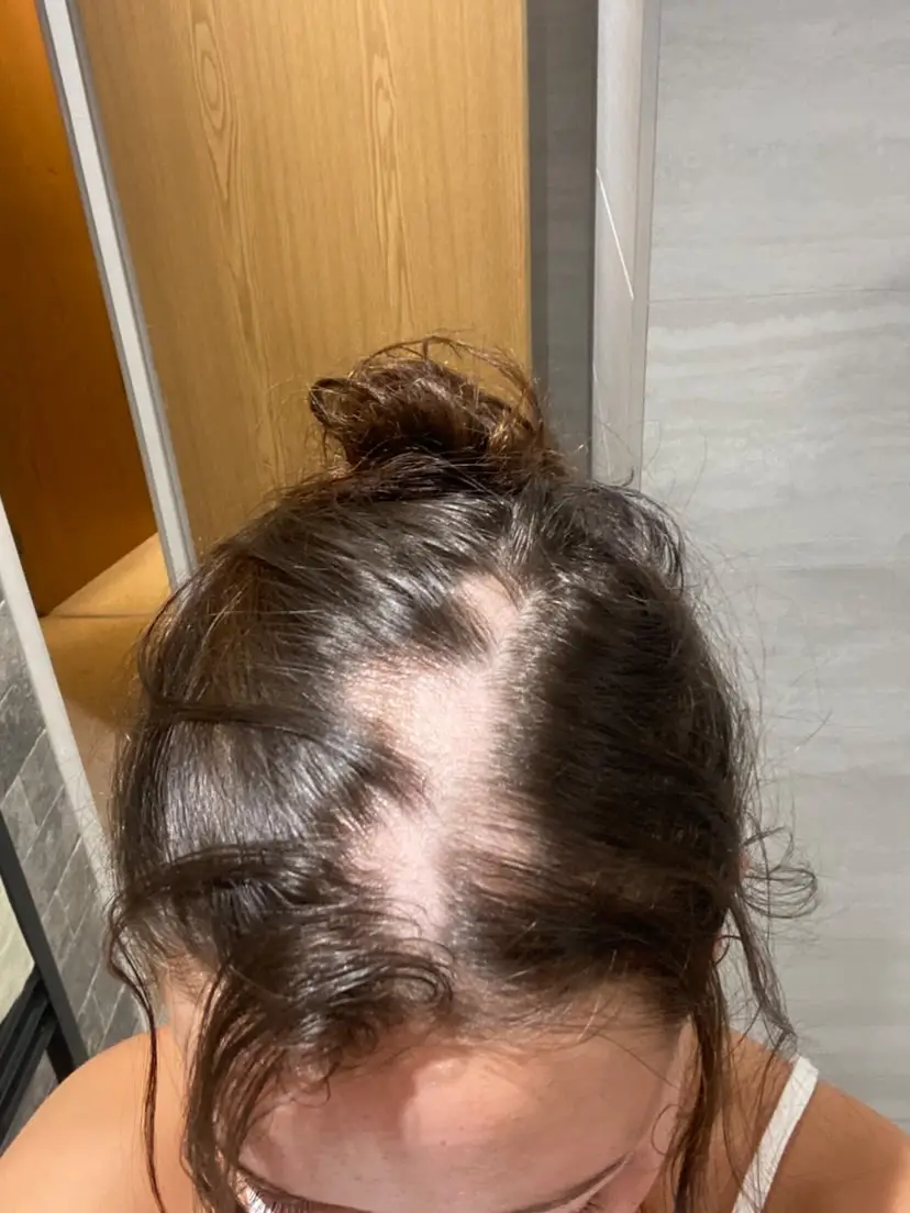 The 23-year-old recalls the hair loss spreading like 'wildfire' from her parting (Supplied)