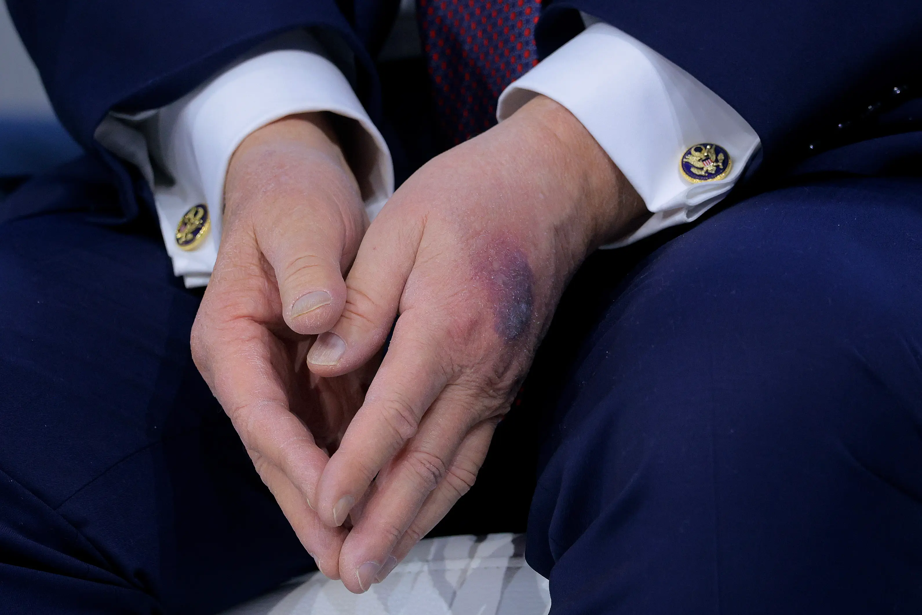A large bruise has been spotted on Trump's left hand (Chip Somodevilla/Getty Images)
