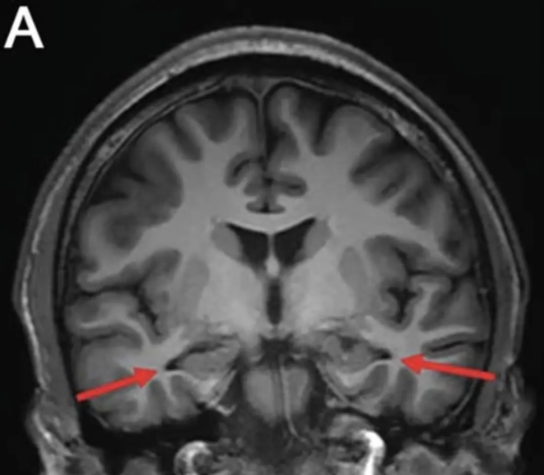 The arrows point out the areas of the 19-year-old's brain which had shrunk due to Alzheimer's (Journal of Alzheimer’s Disease)