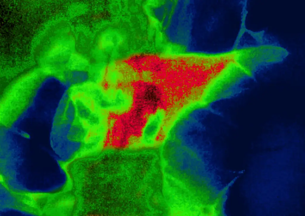 Most cases of acute pancreatitis recover in time, but in the most severe cases there are painful symptoms and it can even be fatal in extreme situations (BSIP/UIG Via Getty Images)