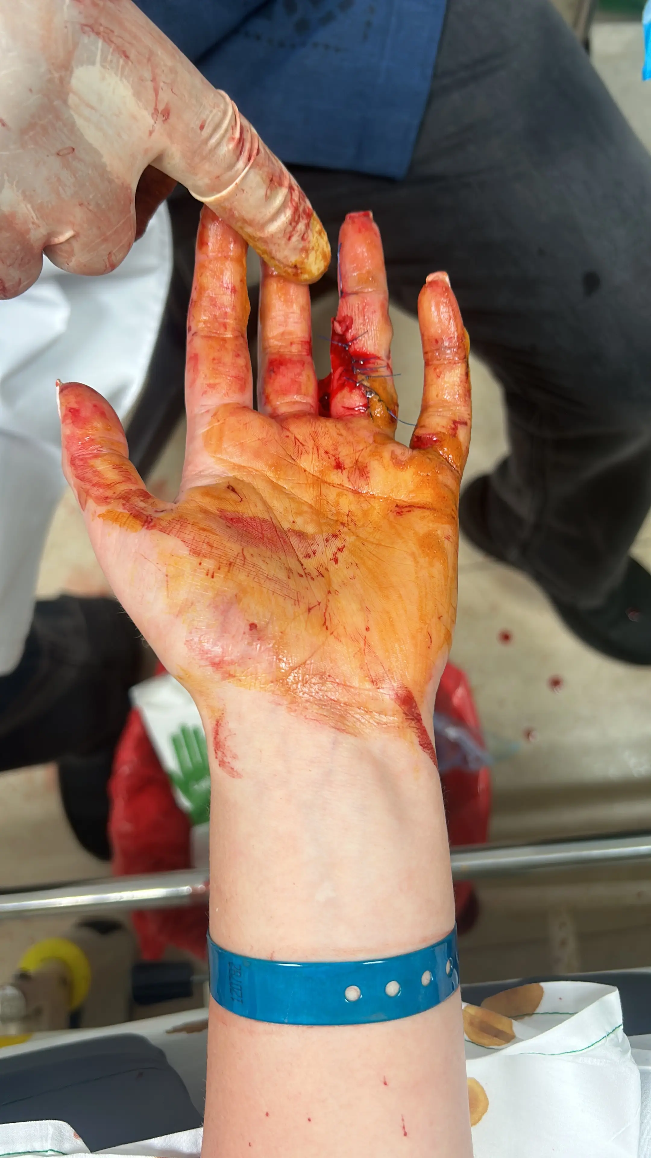 The shark bit Rachel's fingers and left one hanging (SWNS)