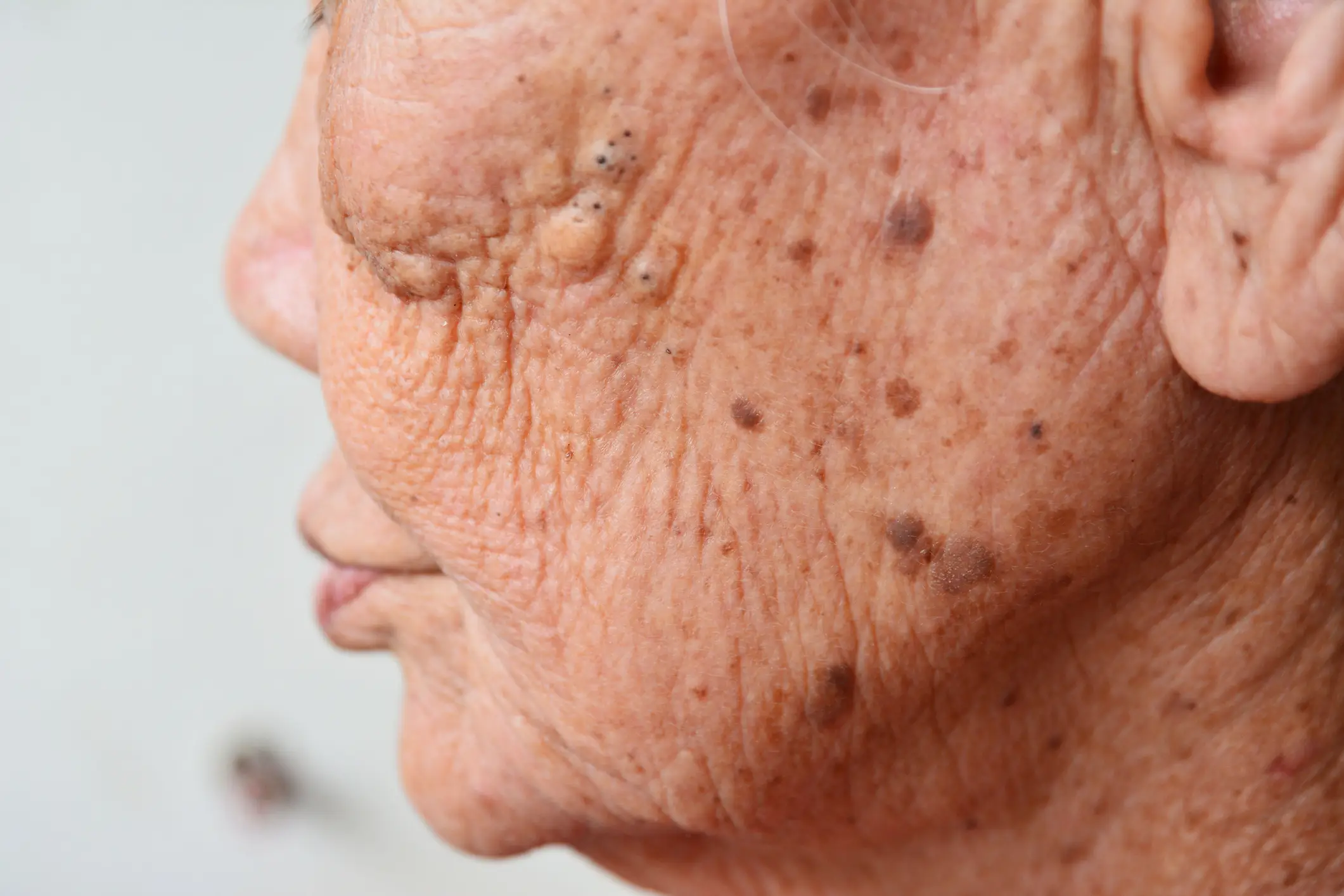 Most bumps and spots are likely to be harmless (Getty Stock Images)