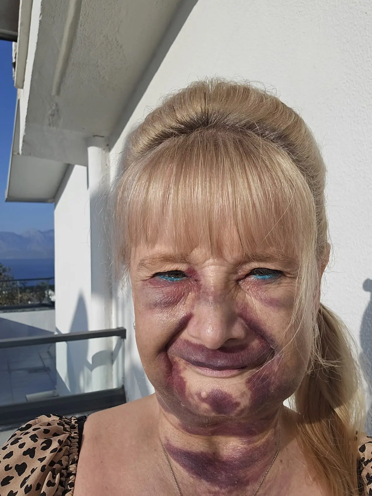 She was left looking unrecognisable (SWNS)