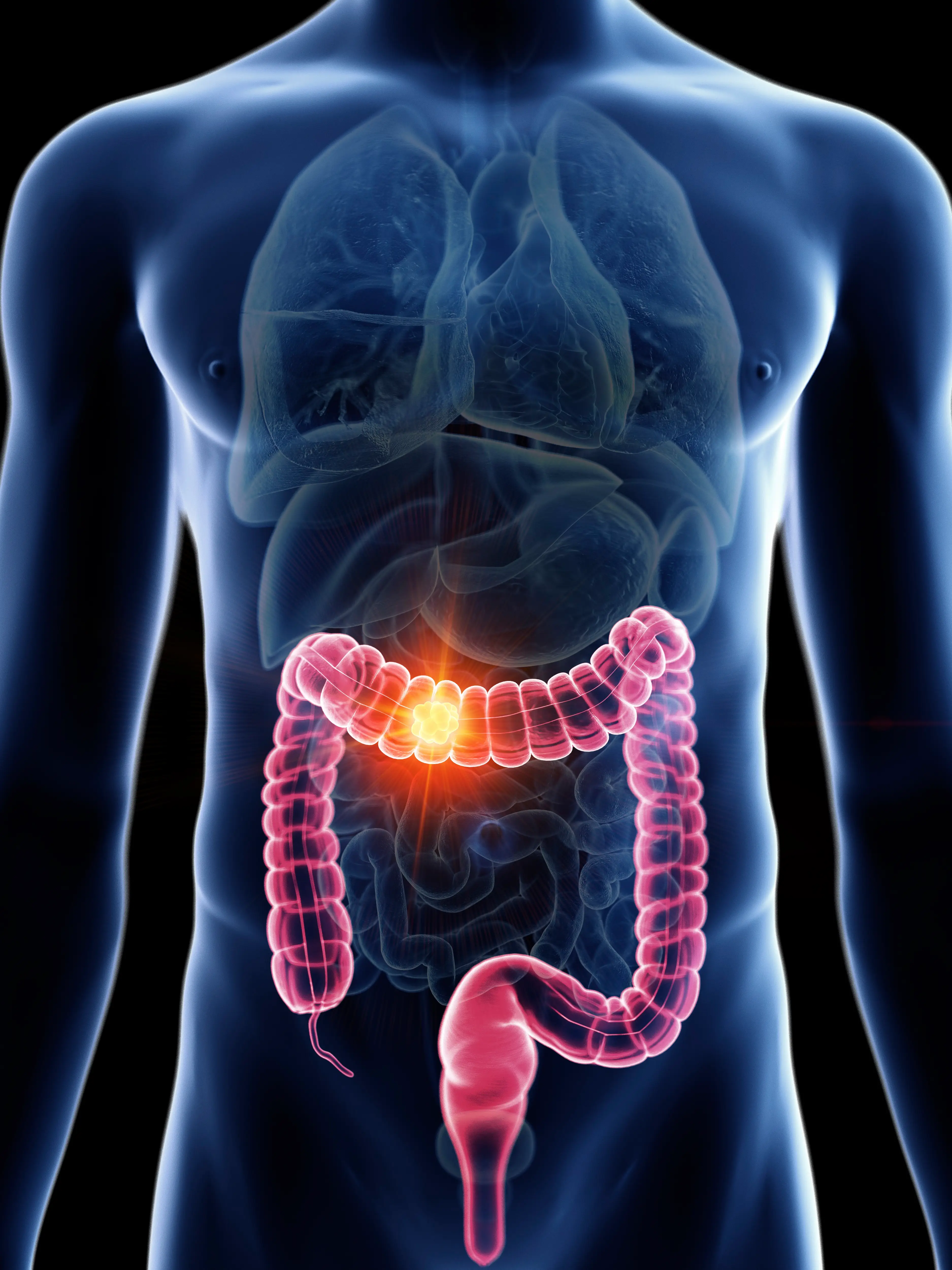 Colon cancer is particularly affecting young people (SCIEPRO/SCIENCE PHOTO LIBRARY/Getty)