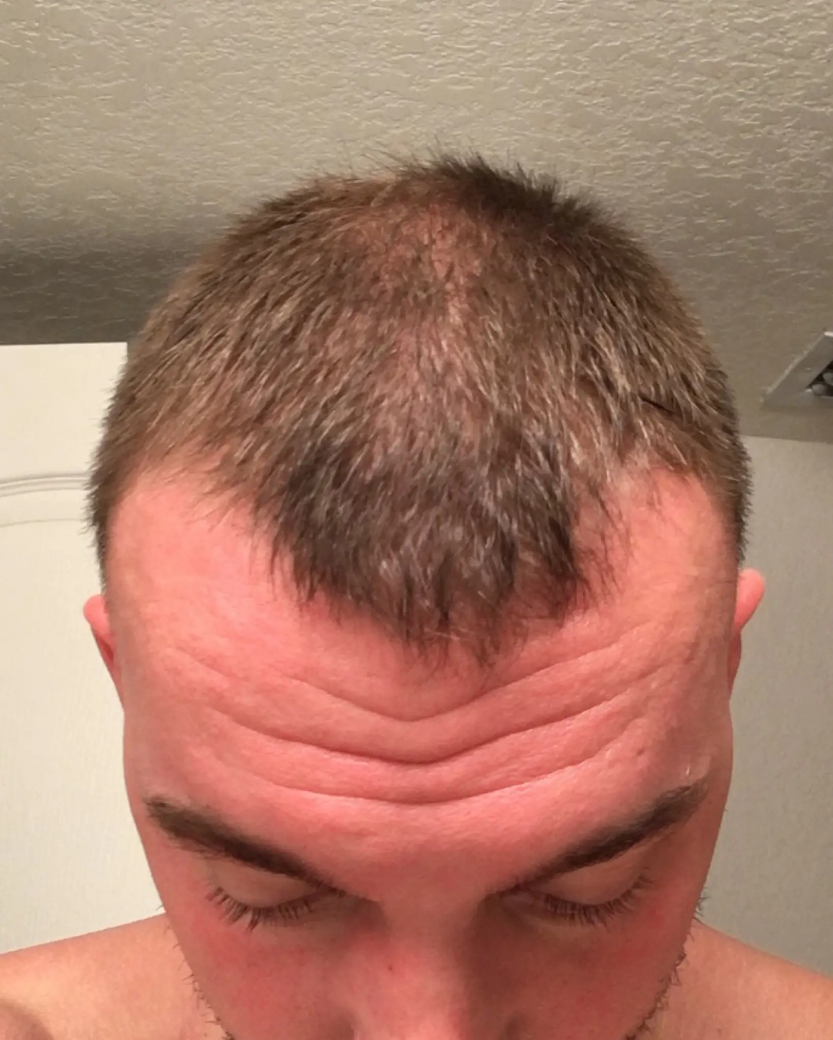 One bloke has shared his before and after photos online (Hims)
